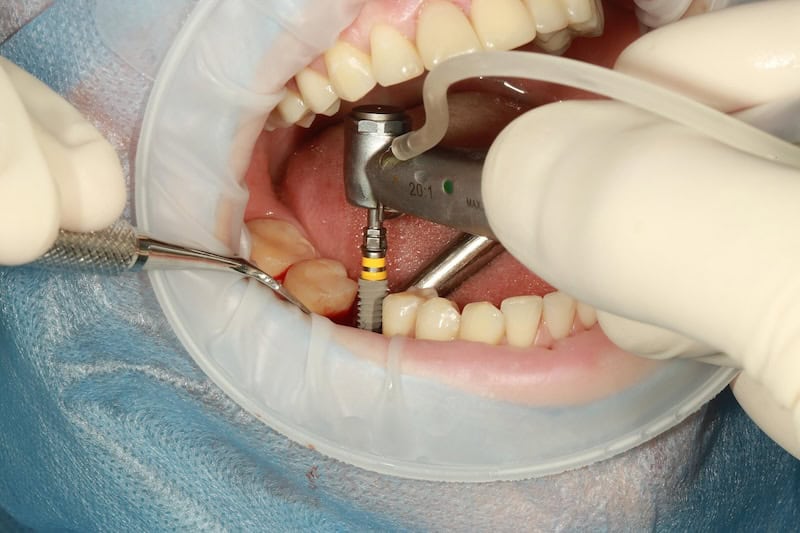 Dental implant